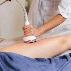 Stretch Marks Treatment 4 sessions